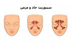 ۹۵ درصد بیماران مبتلا به سینوزیت مزمن بدون نیاز به جراحی درمان میشوند ۹۵ درصد بیماران مبتلا به سینوزیت مزمن بدون نیاز به جراحی درمان میشوند