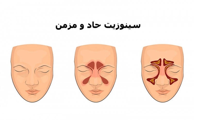 ۹۵ درصد بیماران مبتلا به سینوزیت مزمن بدون نیاز به جراحی درمان میشوند